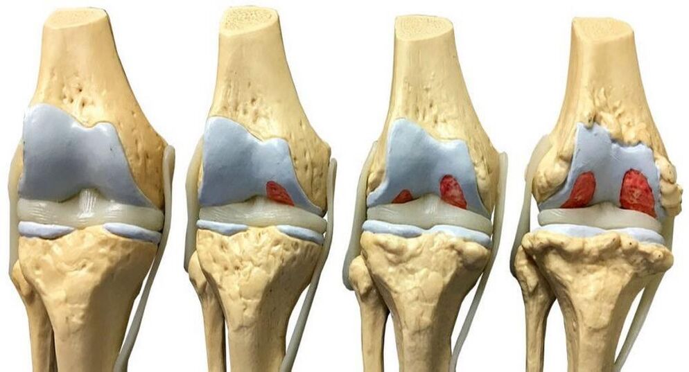 Entwicklungsstadien der Arthrose des Kniegelenks