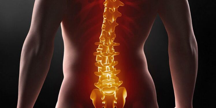 Qualvolle Schmerzen im unteren Rücken - ein Symptom des III. Stadiums der lumbalen Osteochondrose