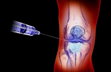 Der Behandlungsplan für Arthrose des Kniegelenks