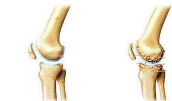 Symptome der Knie -Basis -Atrokyse