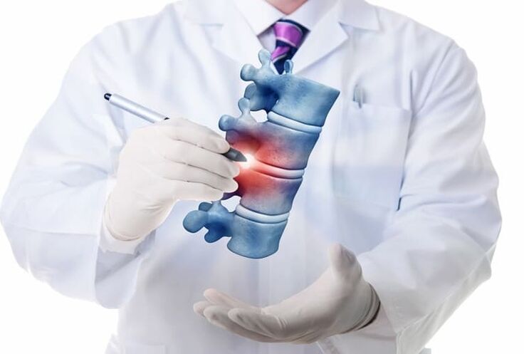 Wirbelsäulenläsionen aufgrund thorakaler Osteochondrose