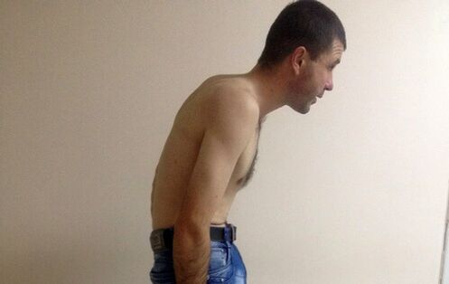 Spondylitis ankylosans kann im Laufe der Jahre Schmerzen im unteren Rückenbereich verursachen