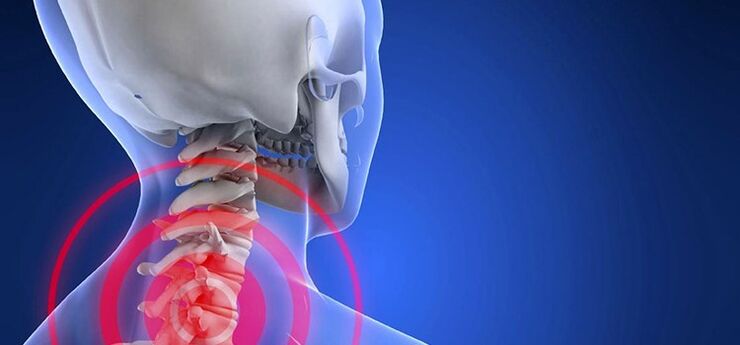 Osteochondrose der Halswirbelsäule